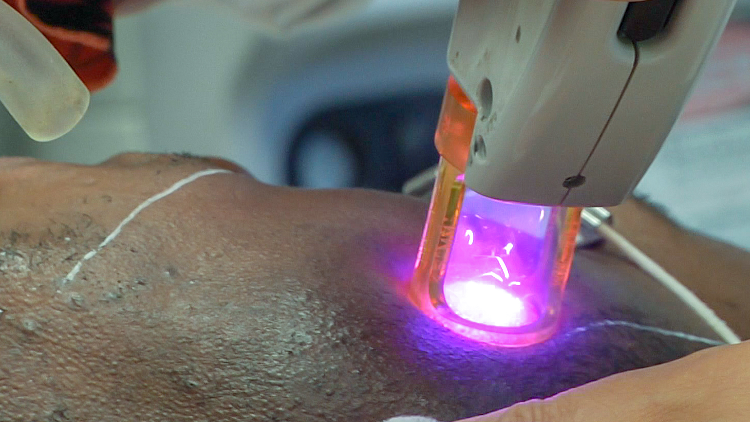 Laser hair removal